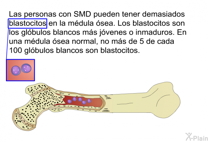 Las personas con SMD pueden tener demasiados blastocitos en la mdula sea. Los blastocitos son los glbulos blancos ms jvenes o inmaduros. En una mdula sea normal, no ms de 5 de cada 100 glbulos blancos son blastocitos.