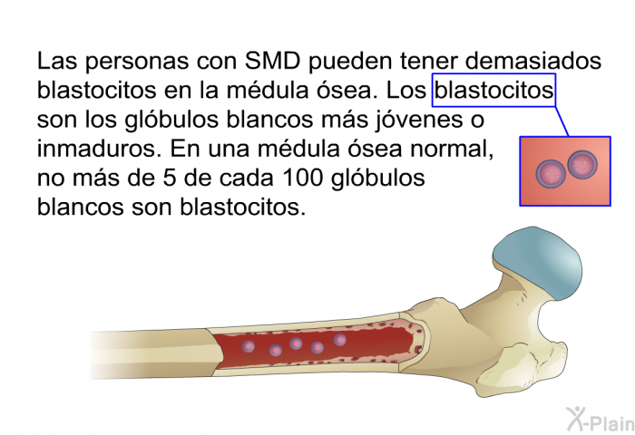 Las personas con SMD pueden tener demasiados blastocitos en la mdula sea. Los blastocitos son los glbulos blancos ms jvenes o inmaduros. En una mdula sea normal, no ms de 5 de cada 100 glbulos blancos son blastocitos.