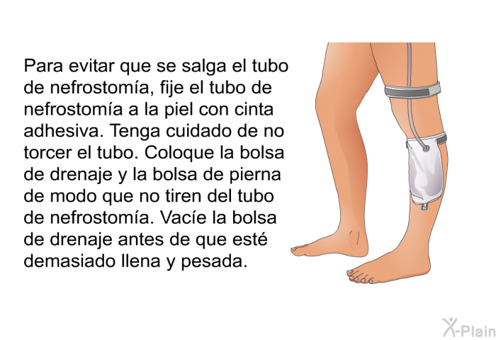 Para evitar que se salga el tubo de nefrostoma, fije el tubo de nefrostoma a la piel con cinta adhesiva. Tenga cuidado de no torcer el tubo. Coloque la bolsa de drenaje y la bolsa de pierna de modo que no tiren del tubo de nefrostoma. Vace la bolsa de drenaje antes de que est demasiado llena y pesada.