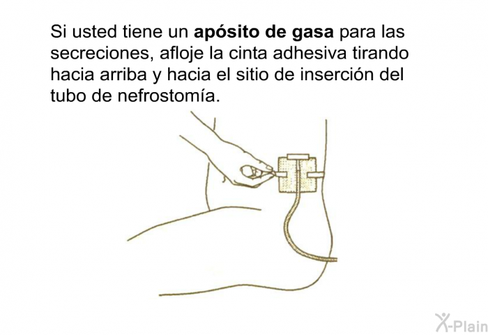 Si usted tiene un<B> apsito de gasa</B> para las secreciones, afloje la cinta adhesiva tirando hacia arriba y hacia el sitio de insercin del tubo de nefrostoma.