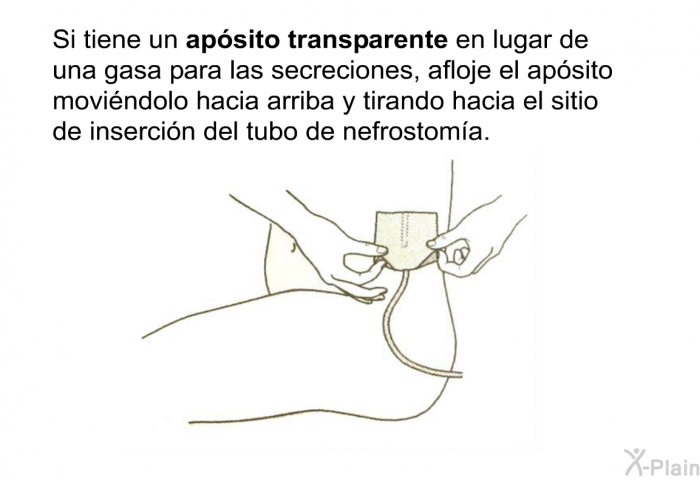 Si tiene un<B> apsito transparente</B> en lugar de una gasa para las secreciones, afloje el apsito movindolo hacia arriba y tirando hacia el sitio de insercin del tubo de nefrostoma.