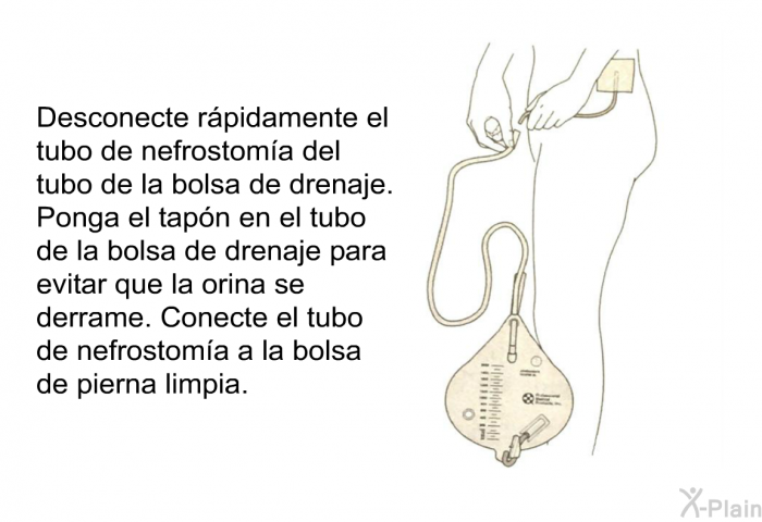 Desconecte rpidamente el tubo de nefrostoma del tubo de la bolsa de drenaje. Ponga el tapn en el tubo de la bolsa de drenaje para evitar que la orina se derrame. Conecte el tubo de nefrostoma a la bolsa de pierna limpia.