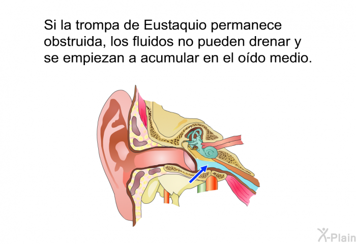 Si la trompa de Eustaquio permanece obstruida, los fluidos no pueden drenar y se empiezan a acumular en el odo medio. 