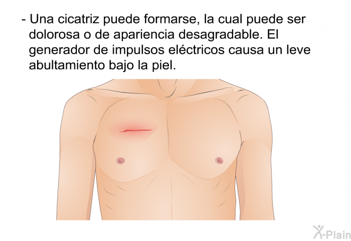 Una cicatriz puede formarse, la cual puede ser dolorosa o de apariencia desagradable. El generador de impulsos elctricos causa un leve abultamiento bajo la piel.