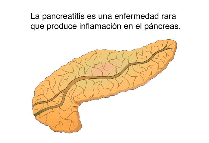 La pancreatitis es una enfermedad rara que produce inflamaci�n en el p�ncreas.
