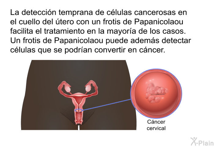 La detecci�n temprana de c�lulas cancerosas en el cuello del �tero con un frotis de Papanicolaou facilita el tratamiento en la mayor�a de los casos. Un frotis de Papanicolaou puede adem�s detectar c�lulas que se podr�an convertir en c�ncer.