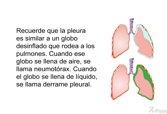 Recuerde que la pleura es similar a un globo desinflado que rodea a los pulmones. Cuando ese globo se llena de aire, se llama neumotrax. Cuando el globo se llena de lquido, se llama derrame pleural.