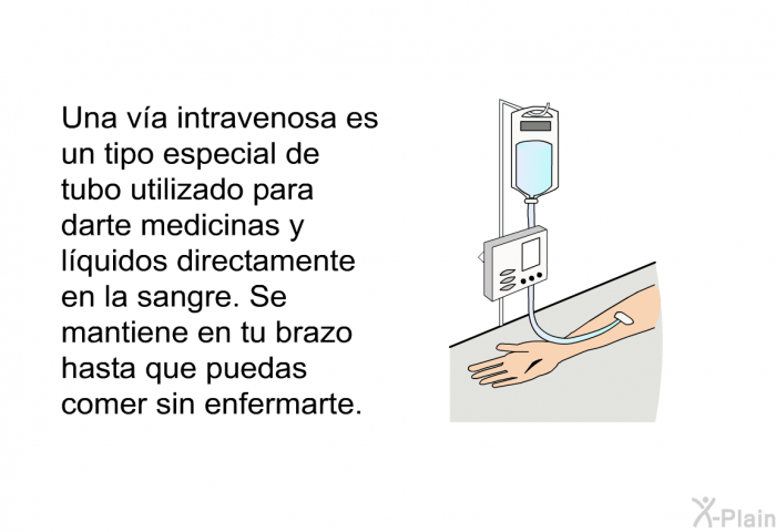 Una va intravenosa es un tipo especial de tubo utilizado para darte medicinas y lquidos directamente en la sangre. Se mantiene en tu brazo hasta que puedas comer sin enfermarte.