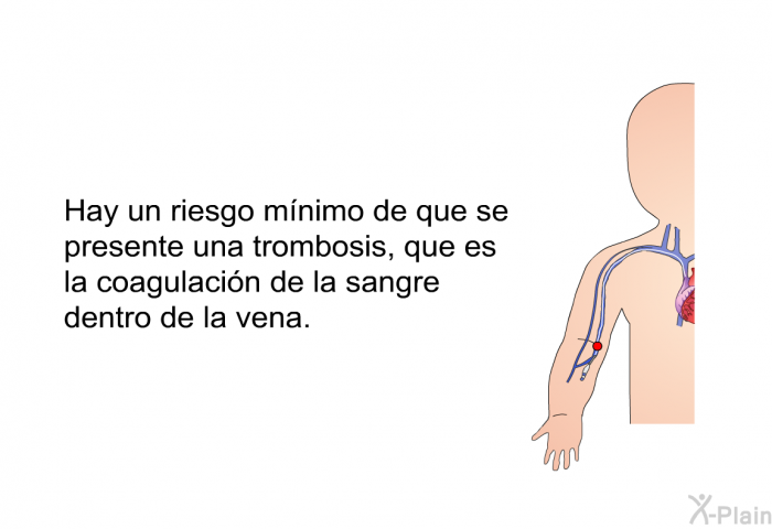 Hay un riesgo mnimo de que se presente una trombosis, que es la coagulacin de la sangre dentro de la vena.