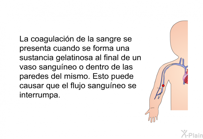 La coagulacin de la sangre se presenta cuando se forma una sustancia gelatinosa al final de un vaso sanguneo o dentro de las paredes del mismo. Esto puede causar que el flujo sanguneo se interrumpa.