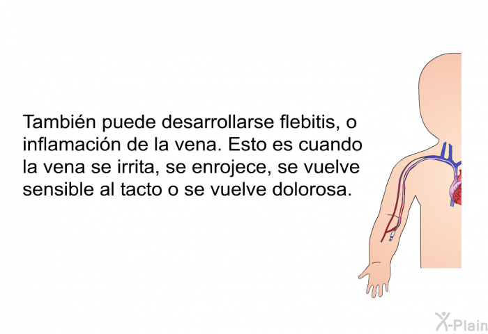 Tambin puede desarrollarse flebitis, o inflamacin de la vena. Esto es cuando la vena se irrita, se enrojece, se vuelve sensible al tacto o se vuelve dolorosa.