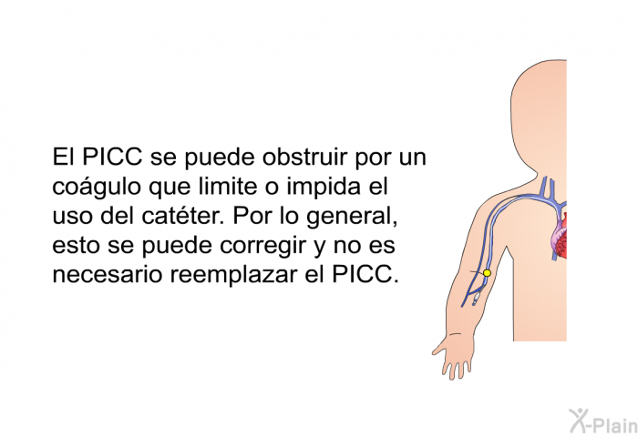 El PICC se puede obstruir por un cogulo que limite o impida el uso del catter. Por lo general, esto se puede corregir y no es necesario reemplazar el PICC.