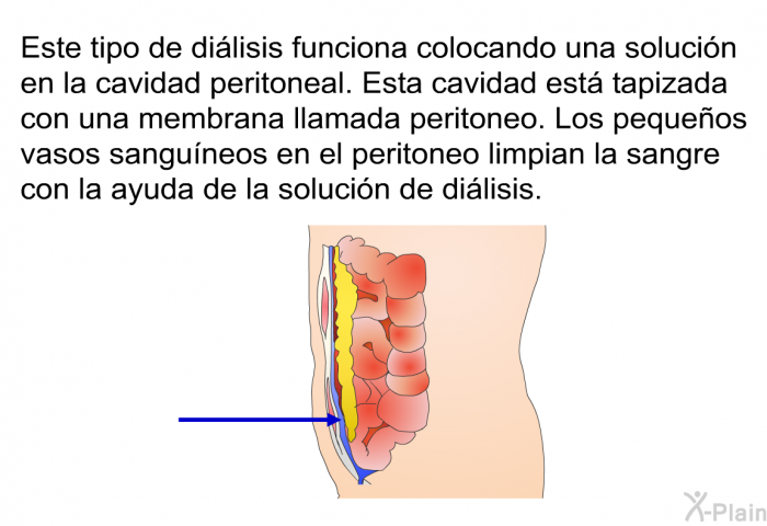 Este tipo de dilisis funciona colocando una solucin en la cavidad peritoneal. Esta cavidad est tapizada con una membrana llamada peritoneo. Los pequeos vasos sanguneos en el peritoneo limpian la sangre con la ayuda de la solucin de dilisis.