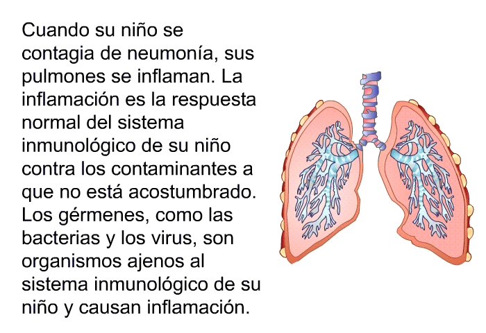 Cuando su nio se contagia de neumona, sus pulmones se inflaman. La inflamacin es la respuesta normal del sistema inmunolgico de su nio contra los contaminantes a que no est acostumbrado. Los grmenes, como las bacterias y los virus, son organismos ajenos al sistema inmunolgico de su nio y causan inflamacin.