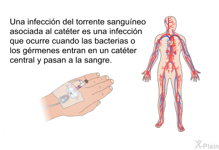 Una infeccin del torrente sanguneo asociada al catter es una infeccin que ocurre cuando las bacterias o los grmenes entran en un catter central y pasan a la sangre.