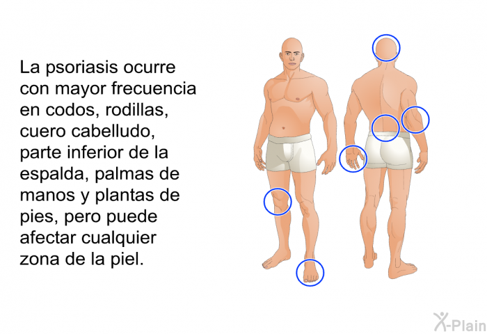 La psoriasis ocurre con mayor frecuencia en codos, rodillas, cuero cabelludo, parte inferior de la espalda, palmas de manos y plantas de pies, pero puede afectar cualquier zona de la piel.