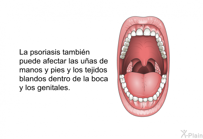 La psoriasis tambin puede afectar las uas de manos y pies y los tejidos blandos dentro de la boca y los genitales.