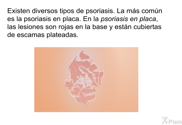 Existen diversos tipos de psoriasis. La ms comn es la <I>psoriasis en placa</I>. En la psoriasis en placa, las lesiones son rojas en la base y estn cubiertas de escamas plateadas.