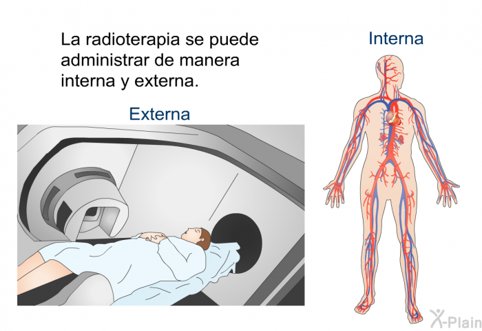 La radioterapia se puede administrar de manera interna y externa.