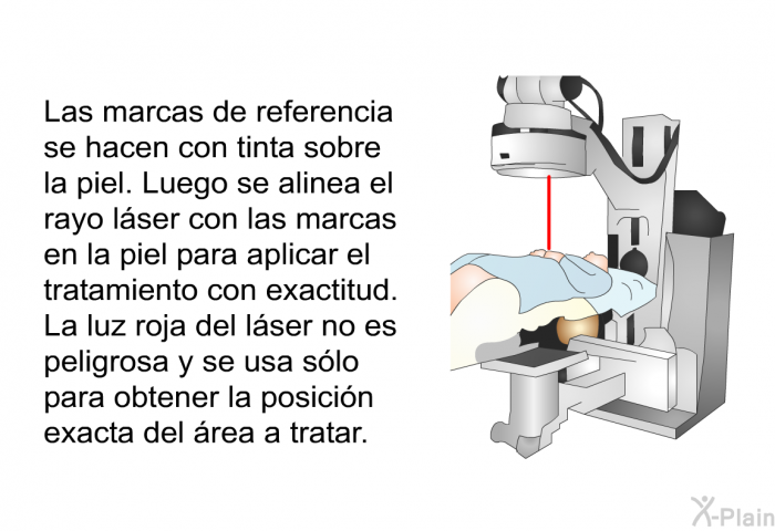 Las marcas de referencia se hacen con tinta sobre la piel. Luego se alinea el rayo lser con las marcas en la piel para aplicar el tratamiento con exactitud. La luz roja del lser no es peligrosa y se usa slo para obtener la posicin exacta del rea a tratar.