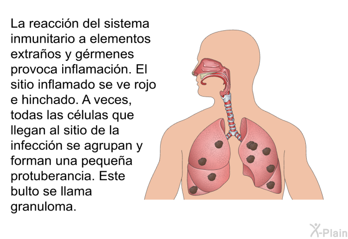 La reaccin del sistema inmunitario a elementos extraos y grmenes provoca inflamacin. El sitio inflamado se ve rojo e hinchado. A veces, todas las clulas que llegan al sitio de la infeccin se agrupan y forman una pequea protuberancia. Este bulto se llama <I>granuloma</I>.