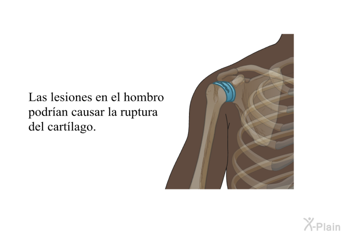 Las lesiones en el hombro podran causar la ruptura del cartlago.