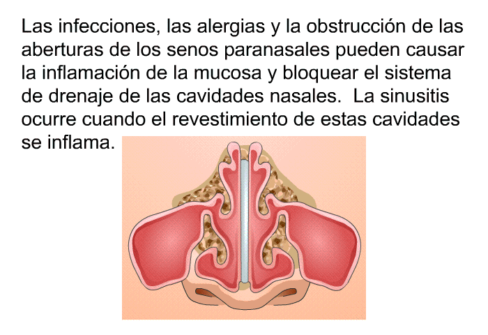 Las infecciones, las alergias y la obstruccin de las aberturas de los senos paranasales pueden causar la inflamacin de la mucosa y bloquear el sistema de drenaje de las cavidades nasales. La sinusitis ocurre cuando el revestimiento de estas cavidades se inflama.