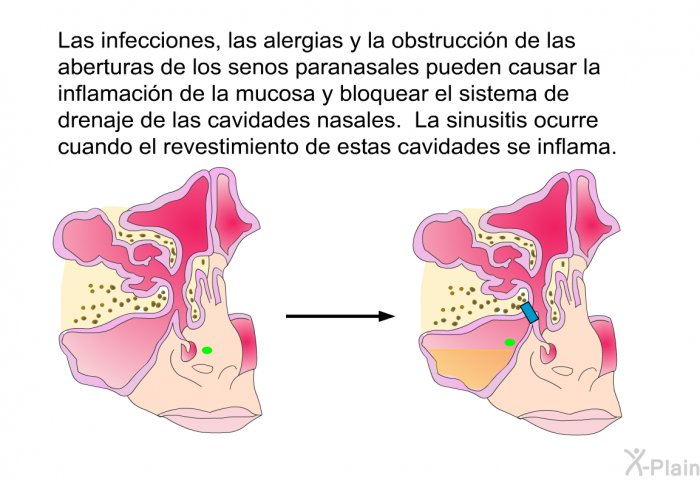 Las infecciones, las alergias y la obstruccin de las aberturas de los senos paranasales pueden causar la inflamacin de la mucosa y bloquear el sistema de drenaje de las cavidades nasales. La sinusitis ocurre cuando el revestimiento de estas cavidades se inflama.