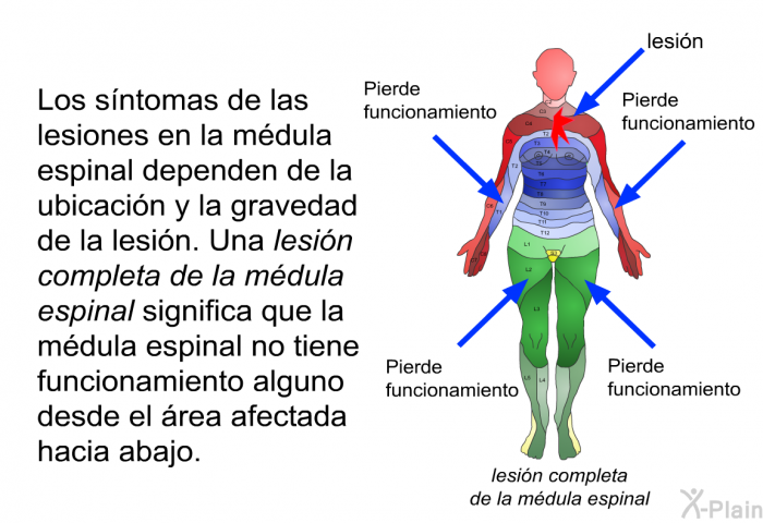 Los sntomas de las lesiones en la mdula espinal dependen de la ubicacin y la gravedad de la lesin. Una <I>lesin completa de la mdula espinal</I> significa que la mdula espinal no tiene funcionamiento alguno desde el rea afectada hacia abajo.