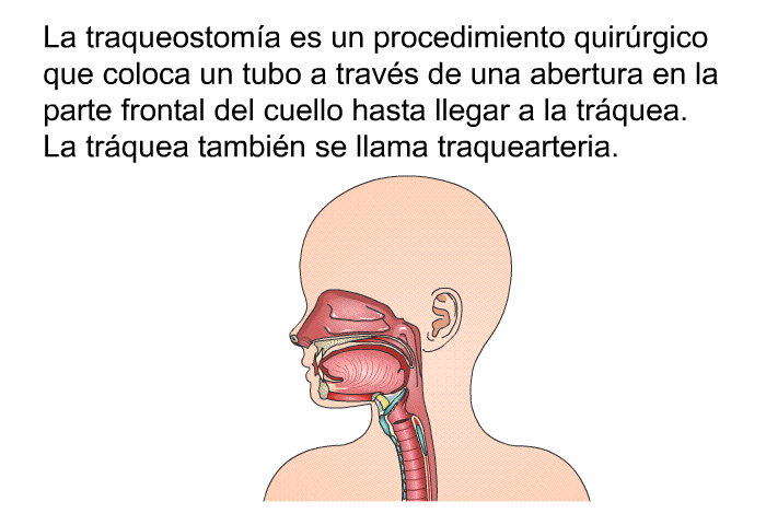 La traqueostoma es un procedimiento quirrgico que coloca un tubo a travs de una abertura en la parte frontal del cuello hasta llegar a la trquea. La trquea tambin se llama traquearteria.