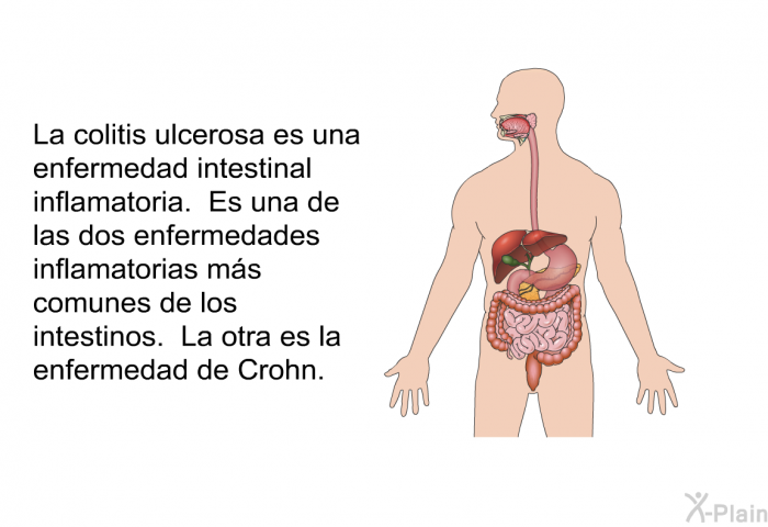 La colitis ulcerosa es una enfermedad intestinal inflamatoria. Es una de las dos enfermedades inflamatorias ms comunes de los intestinos. La otra es la enfermedad de Crohn.