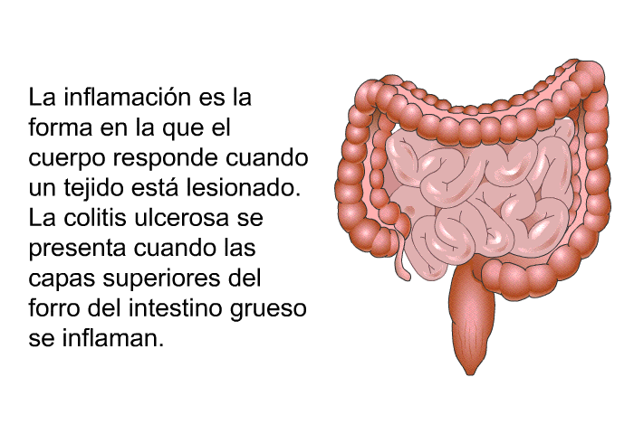 La inflamacin es la forma en la que el cuerpo responde cuando un tejido est lesionado. La colitis ulcerosa se presenta cuando las capas superiores del forro del intestino grueso se inflaman.
