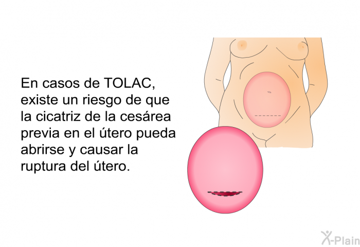 En casos de TOLAC, existe un riesgo de que la cicatriz de la cesrea previa en el tero pueda abrirse y causar la ruptura del tero.