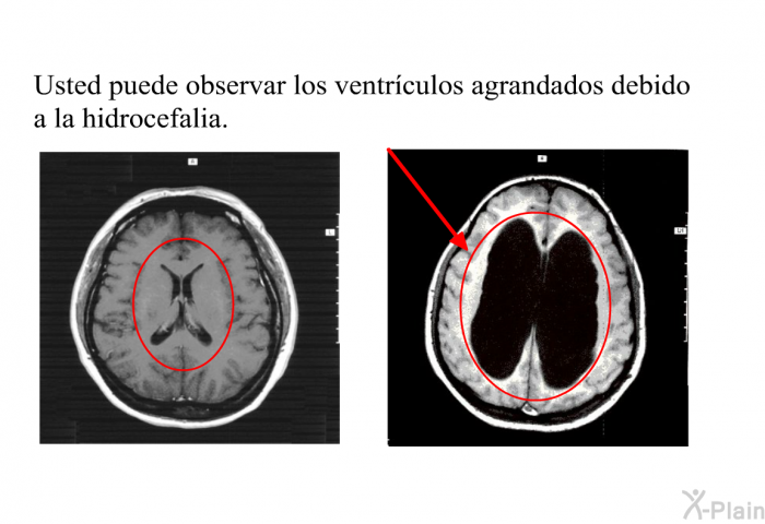 Usted puede observar los ventrculos agrandados debido a la hidrocefalia.