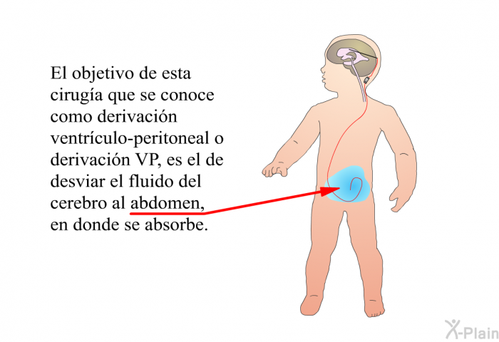 El objetivo de esta ciruga que se conoce como derivacin ventrculo-peritoneal o derivacin VP, es el de desviar el fluido del cerebro al abdomen, en donde se absorbe.