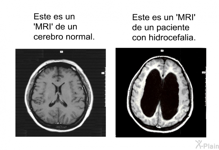 Este es un  MRI' de un cerebro normal. Este es un 'MRI' de un paciente con hidrocefalia.