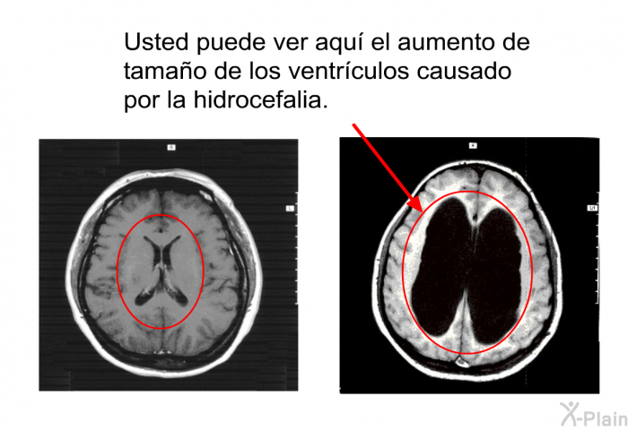 Usted puede ver aqu el aumento de tamao de los ventrculos causado por la hidrocefalia.